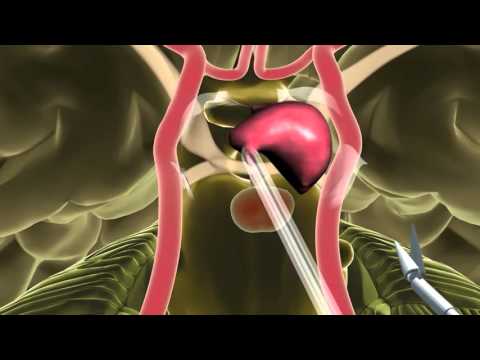 Endoscopic Endonasal Skull Base Surgery  Minimally Invasive Brain Surgery