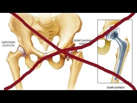 Poszttraumás artroxis a bokaízület 2 fokozatú kezelésében