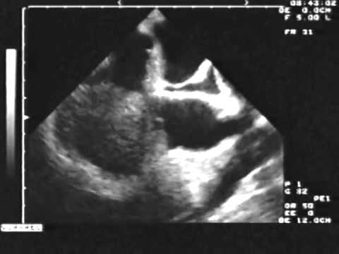 Huge Right Atrial Melanoma
