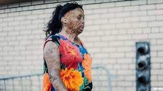 The Flesh-Eating Drug Taking Over Canada, Vancouver  | Documentary