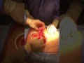 Small Bowel Intussuception From Lipoma Fatty Tumor