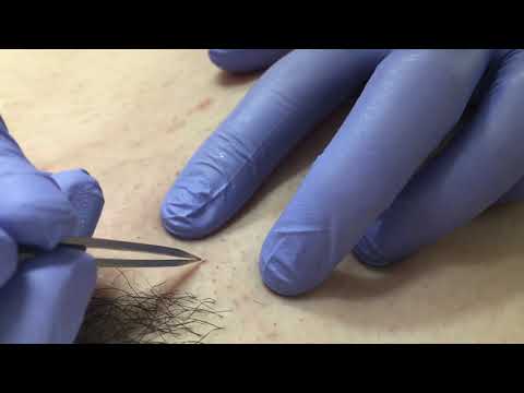 Ingrown Hair Extraction at Southern Sugaring
