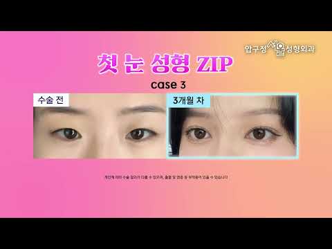 2025년에도 Chill한 눈성형.zip ✨ 압구정서울성형외과