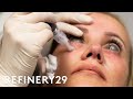 The Truth About This Controversial Injection Trend | Shady | Refinery29 The Truth About This Controversial Injection Trend | Shady | Refinery29
