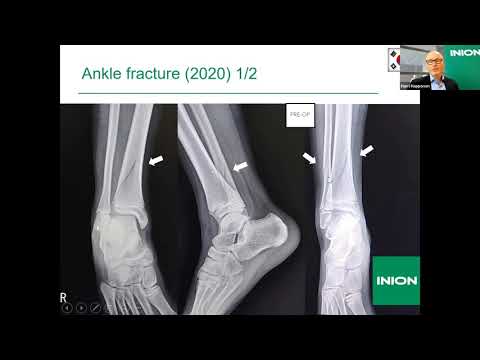 Inion Webinar: Harri Happonen - The First 20 Years with Inion Bioabsorbable Implants