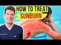Doctor explains HOW TO TREAT SUNBURN | Top 5 things to do & avoid to help your skin