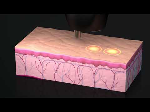 How NeoGen Plasma Works