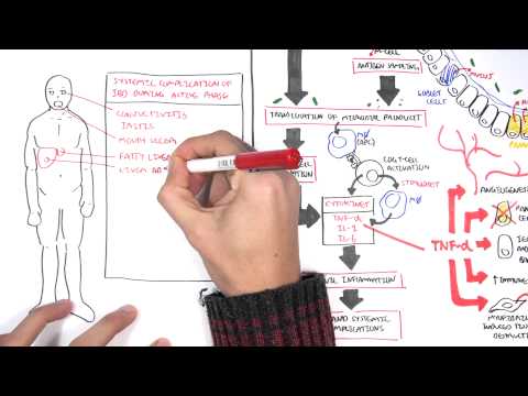 Inflammatory Bowel Disease - Pathophysiology and Complications