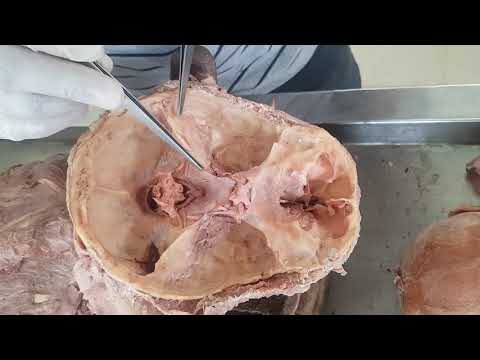 Dural folds and Dural venous sinuses - Gross Anatomy ( Dissection )