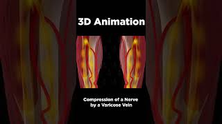 Download lagu Exploring Varicose Veins and Nerve Signals: A 3D Animation mp3