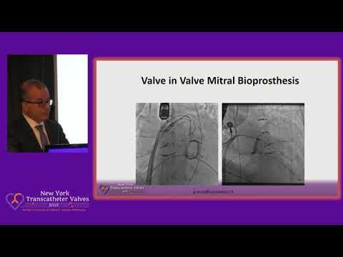 Transcatheter Valvular Techniques: Complex TAVR Case - Dr. Gian Paolo Ussia