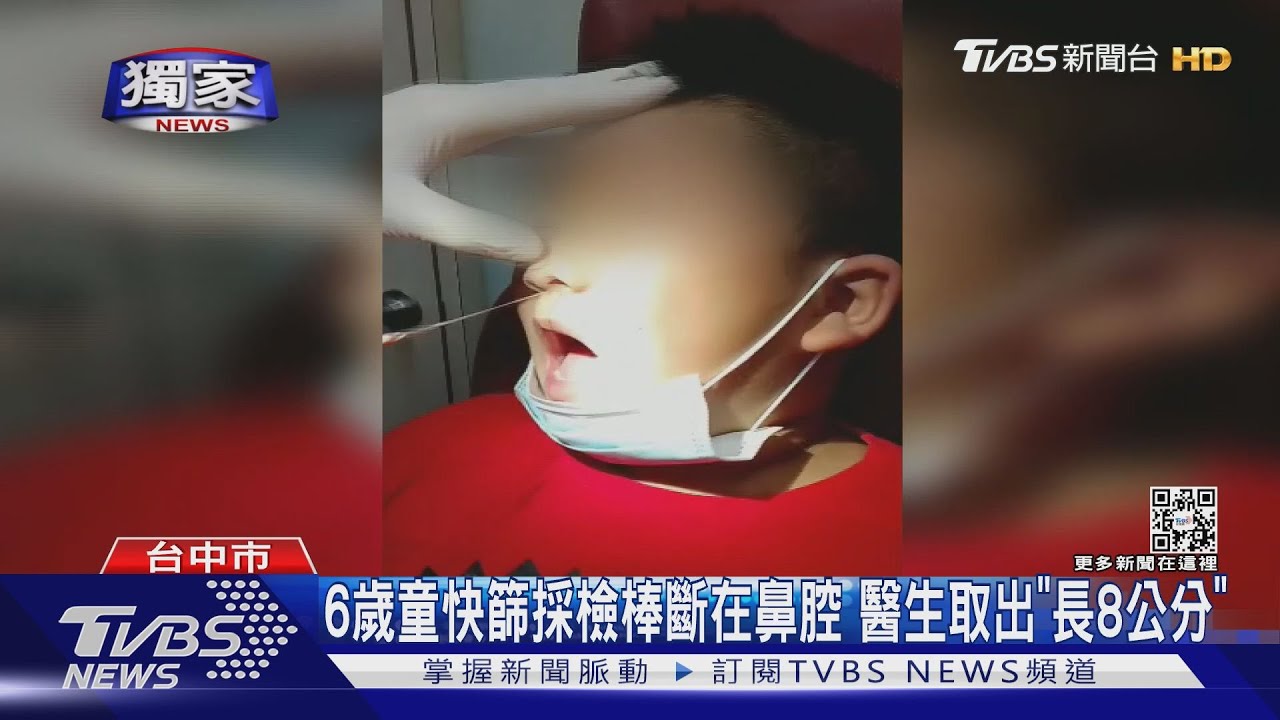 6歲童快篩採檢棒斷在鼻腔　醫生取出「長8公分」