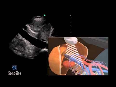 How to: Inferior Vena Cava Ultrasound Exam 3D Video