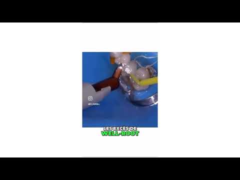 Coiffage pulpaire direct avec Well-root – Endodontie