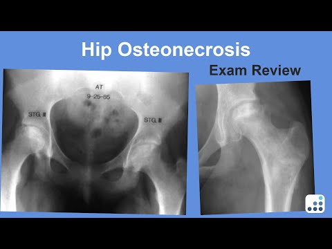 Hip Osteonecrosis Exam Review - William Jiranek, MD