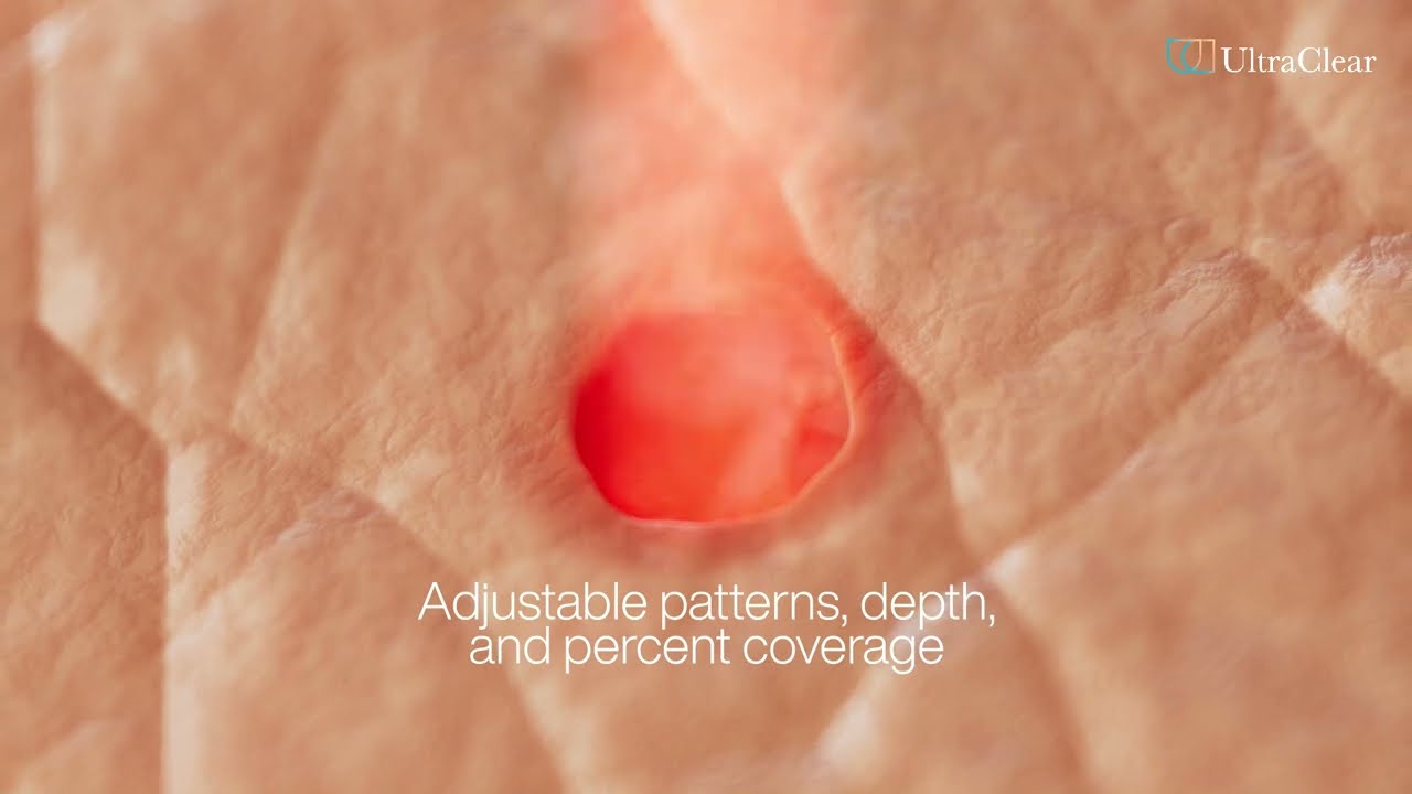 UltraClear® Laser Coring animation