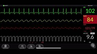 Download lagu Simulated Patient Monitor mp3 Download lagu Simulated Patient Monitor mp3