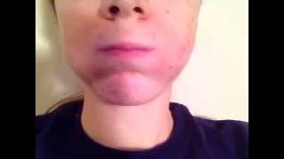 facial twitching spasm...is it essential tremor don't know cause