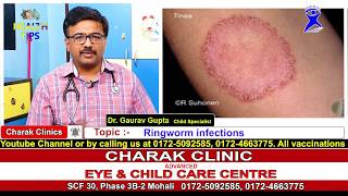 Ringworm Infections in children - why does it happen and how to prevent and treat it