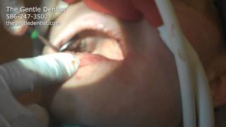 preview picture of video 'Wisdom Teeth Removal in Shelby Township, Michigan - Part 2 Graphic'