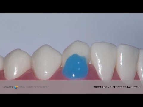 Dental Bonding Tips: Total-Etch with Prime&Bond® elect | Dentsply Sirona