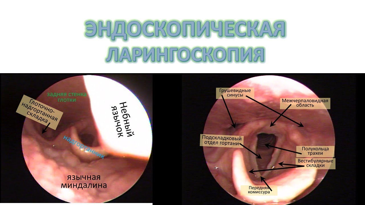 ЭНДОСКОПИЧЕСКАЯ ЛАРИНГОСКОПИЯ НОРМА 