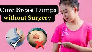 Cure Breast Lump Without Surgery | Breast Fibroadenoma | Non Surgical Treatment