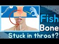 What to Do When a Fish Bone Gets Stuck in Your Throat