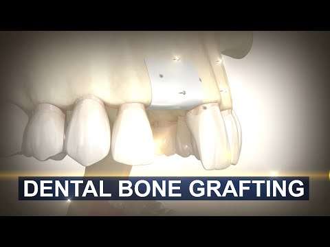 Bone Grafting for Dental Implants in 3D Animation | Maxillofacial & Dental Implant Surgery