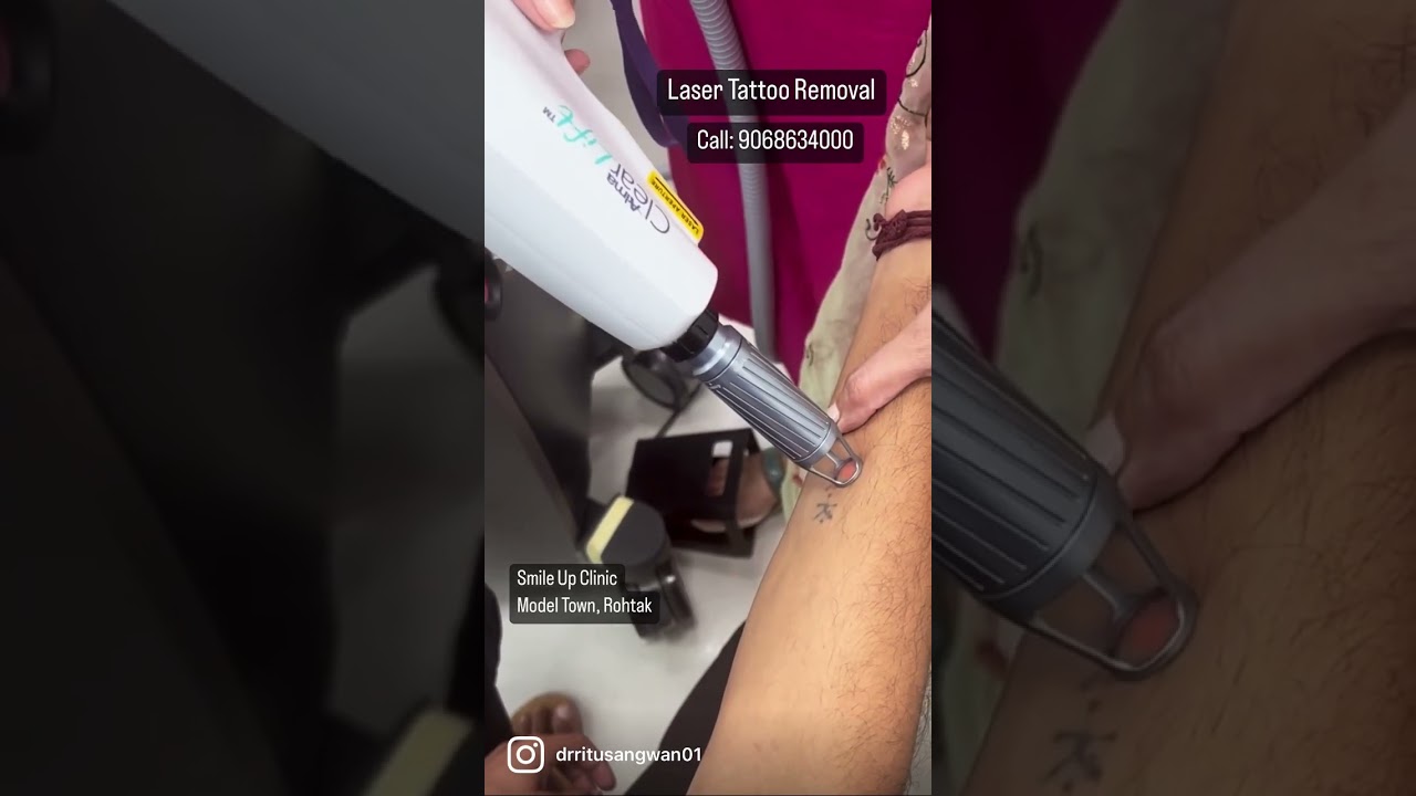 Painless Laser Tattoo Removal withHarmony XL Pro (Clearlift) #shorts #youtubeshorts #tattoo #laser