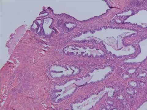 Enterobius vermicularis cuadro clinico