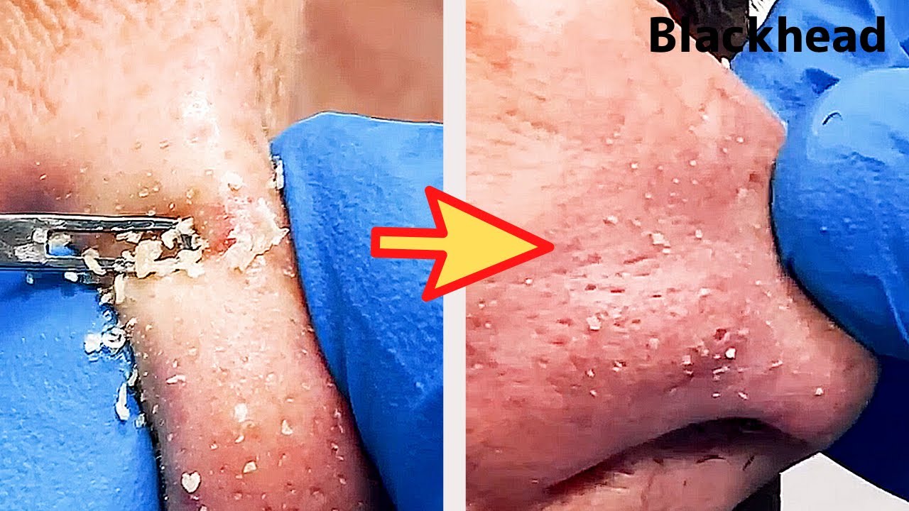 【角栓除去】鼻からドバっと！大量のニキビを芯出しするのって気持ちいい／Blackhead Removal Show