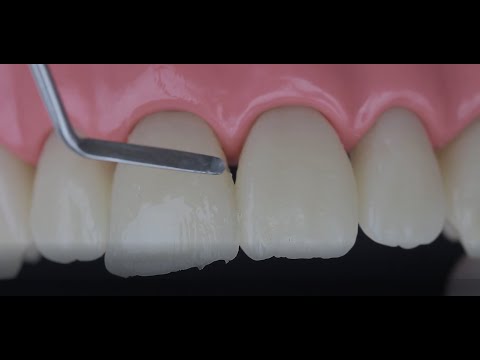 Preclinical Dentistry - Anterior Composite Restoration