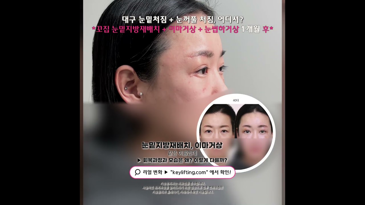 40대 눈밑과 눈꺼풀 처짐을 위한 리프팅