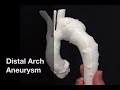 Minimally Invasive Total Arch Replacement And Frozen Elephant Trunk