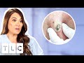 Top 5 Pimple Popping Moments: From A 55-Year-Old Blackhead To Oozing Fistulas!!