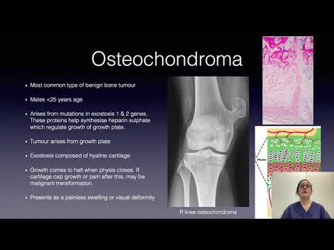 Benign Bone Tumours by Dr Sabine Wagner