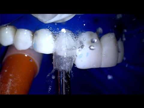 The Bioclear360° Veneer