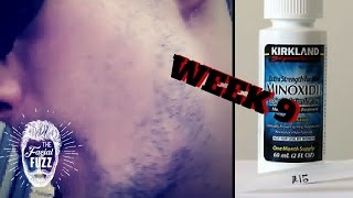 Minoxidil Beard | Week 9 | The Experiment |  #FacialFuzzFridays