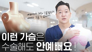 수술 후가 B컵… 최선입니까?