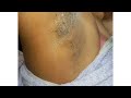 Thin Underarms Waxing With Honey Wax ️