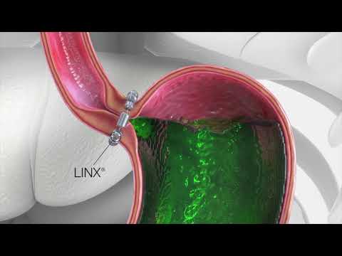 LINX Reflux Surgery Animation