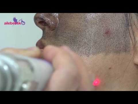 download lagu mp3 mp4 Karbon Peeling, download lagu Karbon Peeling gratis, unduh video klip Karbon Peeling