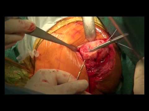 Reverse Shoulder Joint Correction In Chronic Rotator Tear