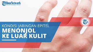 Papiloma, Benjolan yang Terbentuk dari Jaringan Epitel yang Menonjol ke Luar