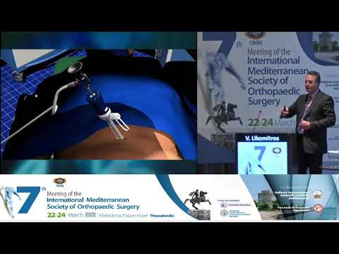 V Likomitros - Laparoscopic fusion with large ALIF cage for high grade spondylosynthesis