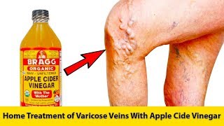 Home Treatment of Varicose Veins With Apple Cide Vinegar | GET RID OF VARICOSE VEINS