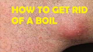 how to get rid of a boil under your armpit fast and easy