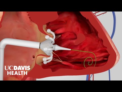 Minimally Invasive Procedures for Structural Heart Disease