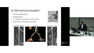 Selecting TAVI Patients – Prof Darren Walters